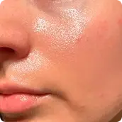 pele-oleosa.webp